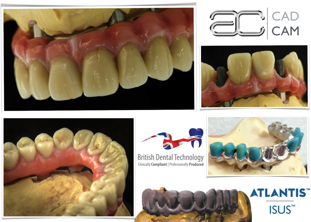 CAD_implant_Bridge