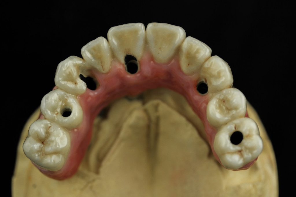 Screw_retained_CADCAM_Chrome_and_ceramic