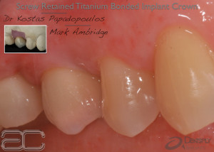 Ambridge_Ceramics_titanium_screw_retained_implant_crown