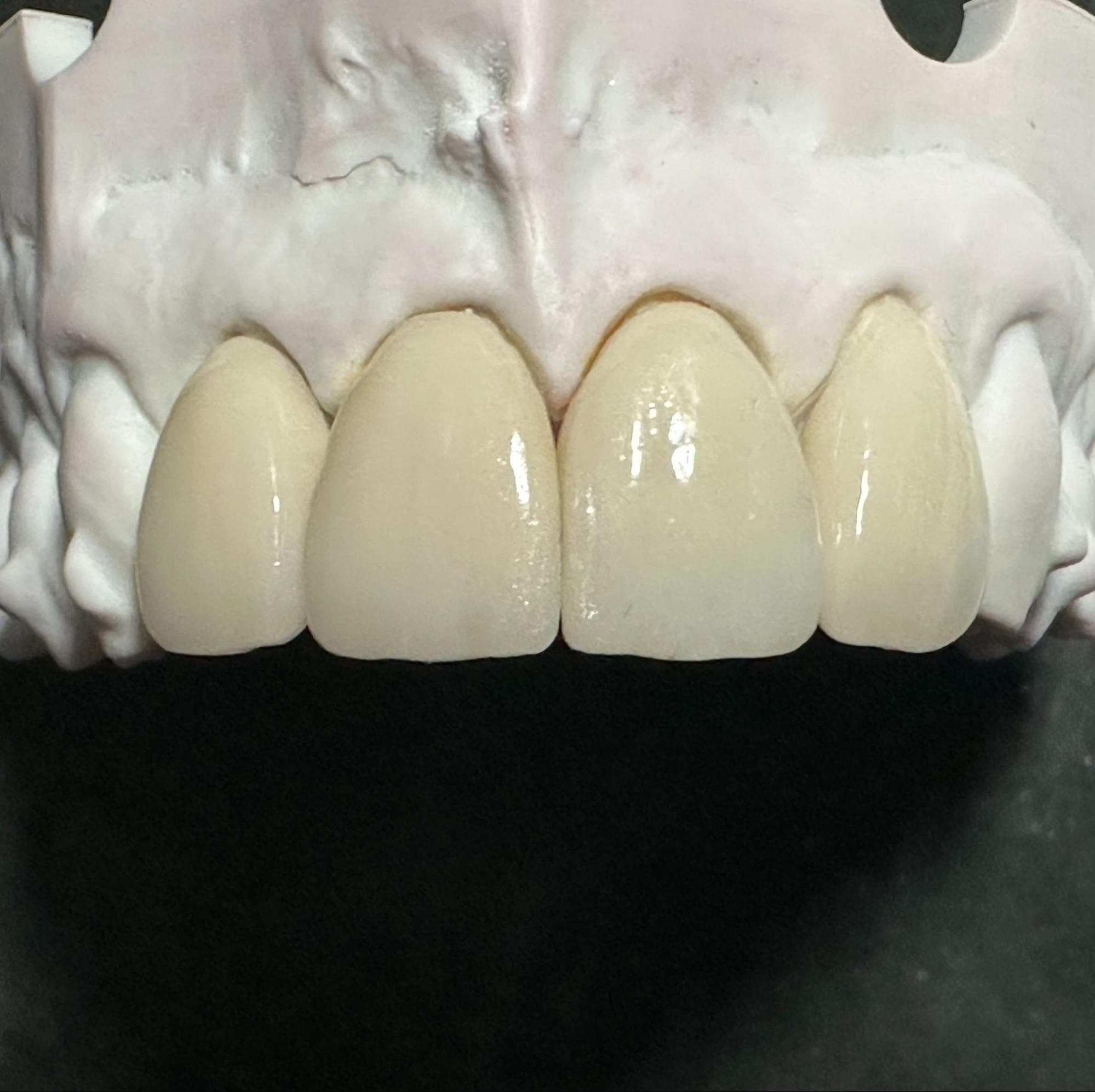 Images: Translucent crown against shade guide, ND shade guide conveying natural prep shade, and final crowns on coloured model