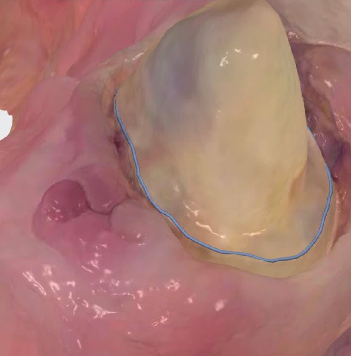 A clean intra-oral scan with a crisp, fully visible margin