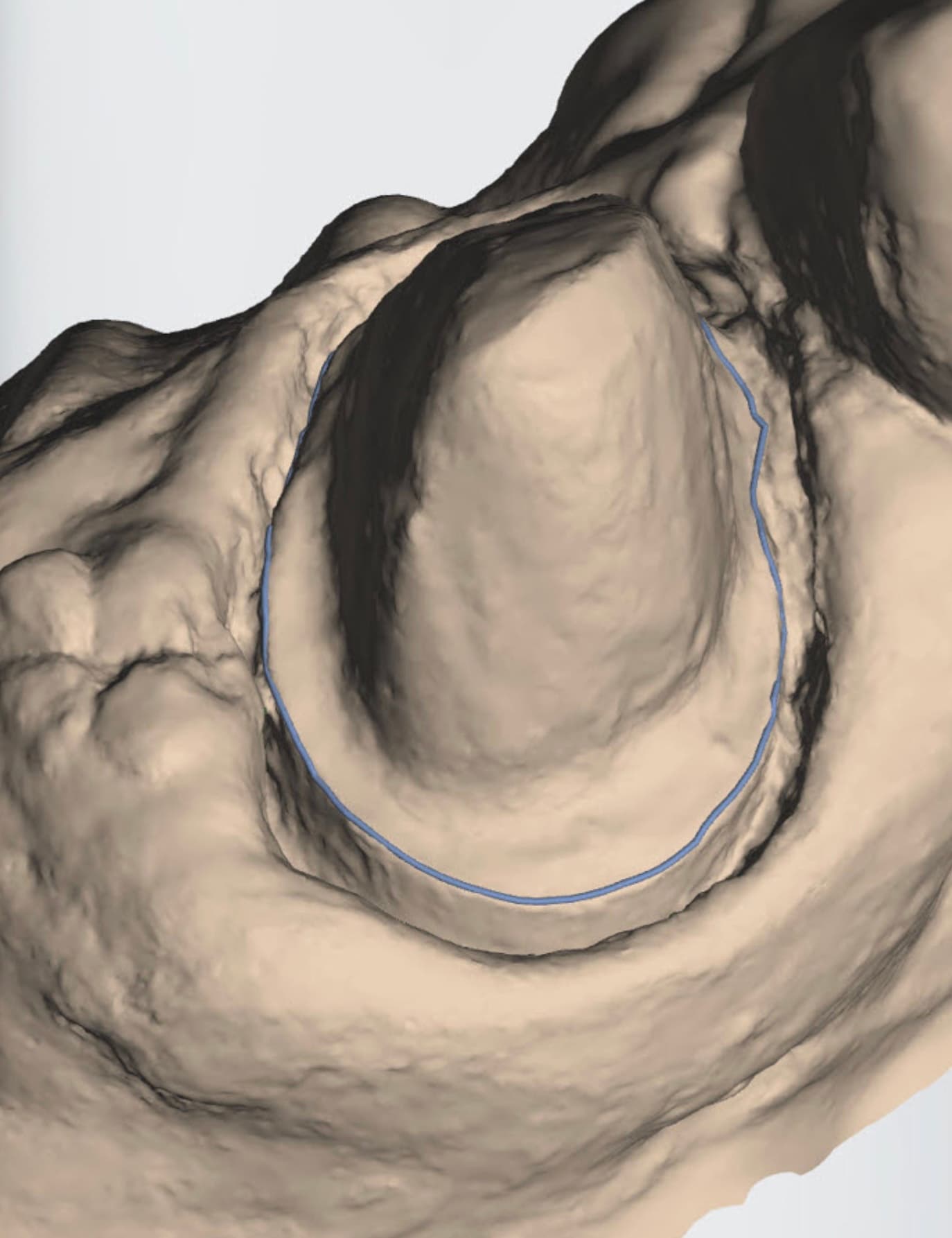 A clean intra-oral scan with a crisp, fully visible margin