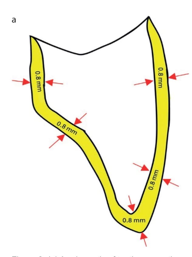 Cross-section showing optimum prep reduction for an all-ceramic restoration