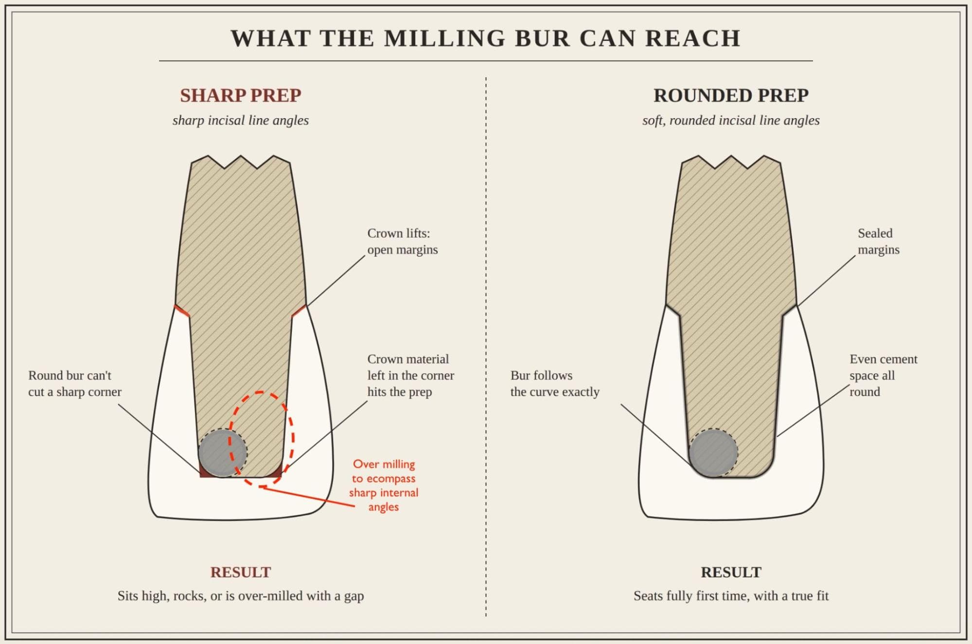 Sharp-angled prep vs Rounded prep. NB: a milling bur being rounded on the tip cannot reproduce a sharp internal angle, so has to 'Overmill' to compensate (dotted line). This can cause thin spots where space is limited.