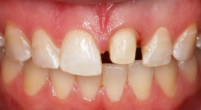 a well-prepared tooth on the model, smooth rounded margins clearly visible