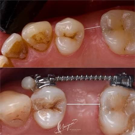 It used to be that opening a space could only be done with bonded/wired ortho.