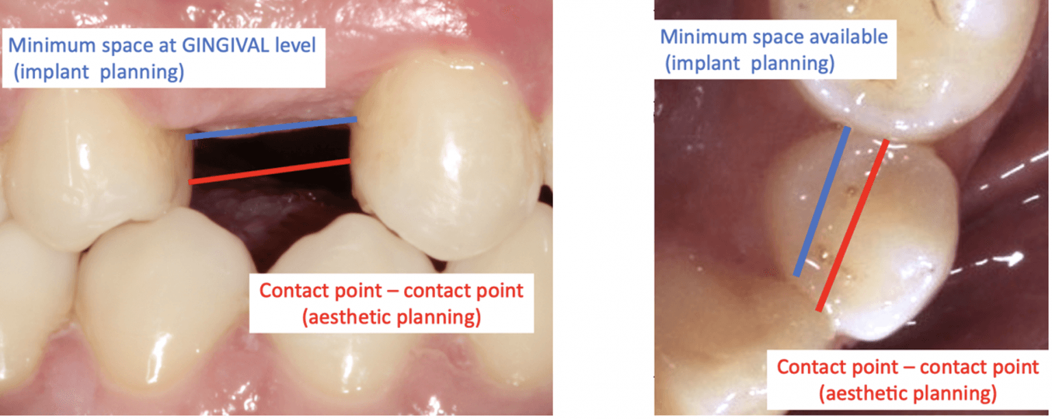 Image 1 & 2. Showing ideal position for interdental measurements