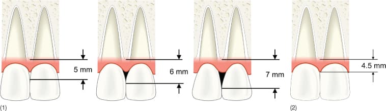 Ideal contact point, the 5mm measurement to the bone crest and the papilla filling the gap (assuming the gingiva 3mm thick av.)
