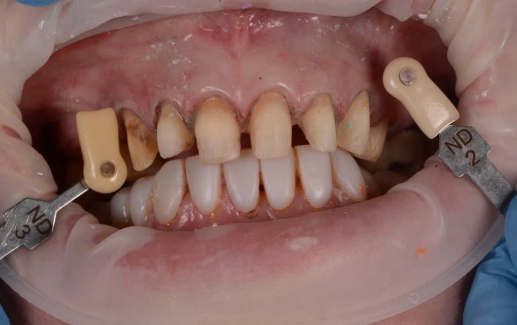Images: 1 preps, 2 restorations & 3 restorations fitted — showing discolouration of preps affecting cemented restorations (BL3 E.max veneers on 11, 21, 22 showing browny/orange tint)
