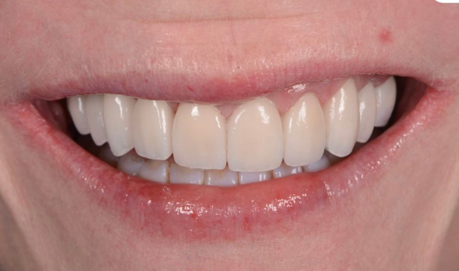 Images: 1 preps, 2 restorations & 3 restorations fitted — showing discolouration of preps affecting cemented restorations (BL3 E.max veneers on 11, 21, 22 showing browny/orange tint)