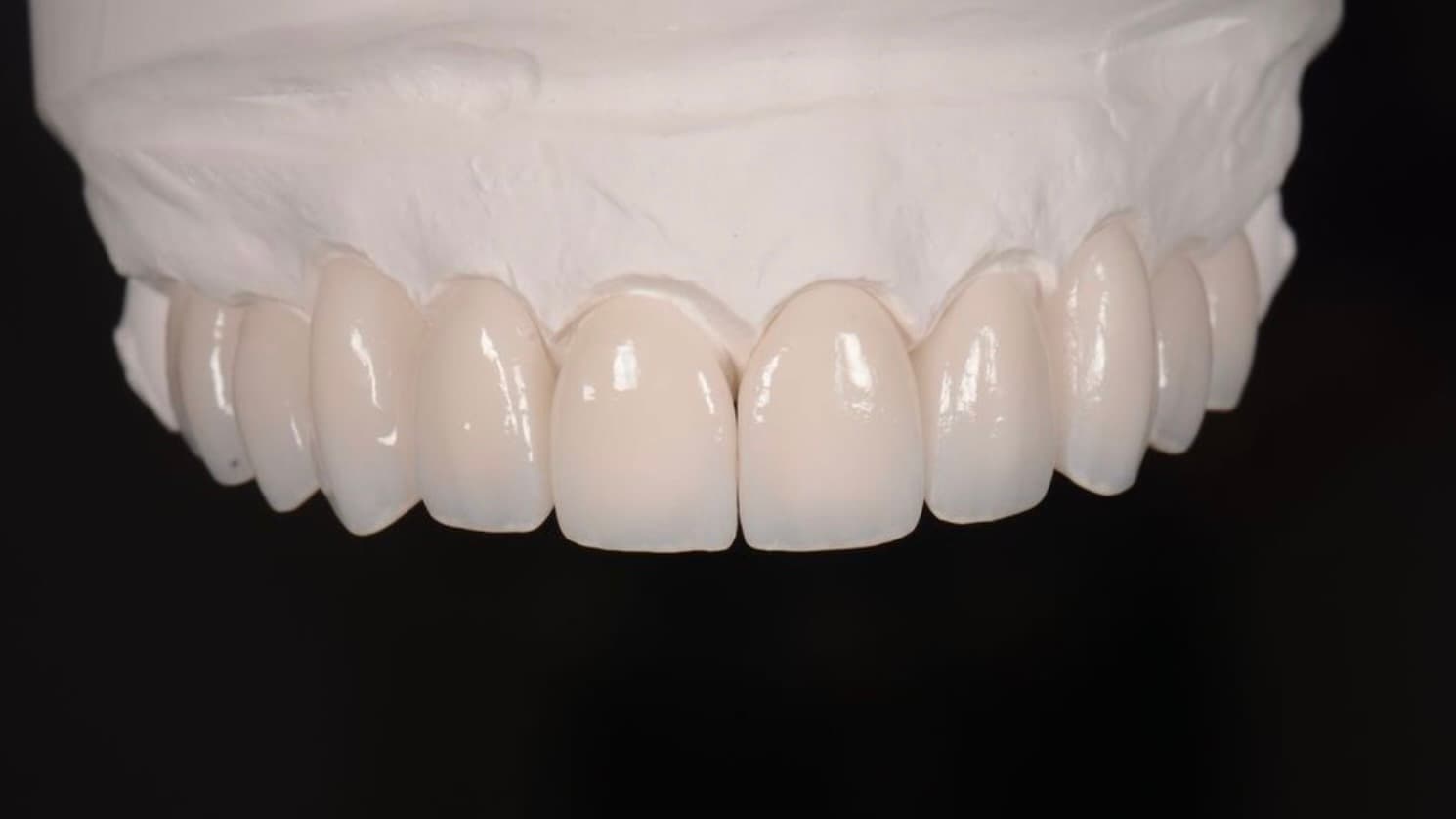 Images: 1 preps, 2 restorations & 3 restorations fitted — showing discolouration of preps affecting cemented restorations (BL3 E.max veneers on 11, 21, 22 showing browny/orange tint)