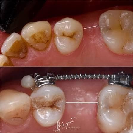 Orthodontic space creation before and during treatment