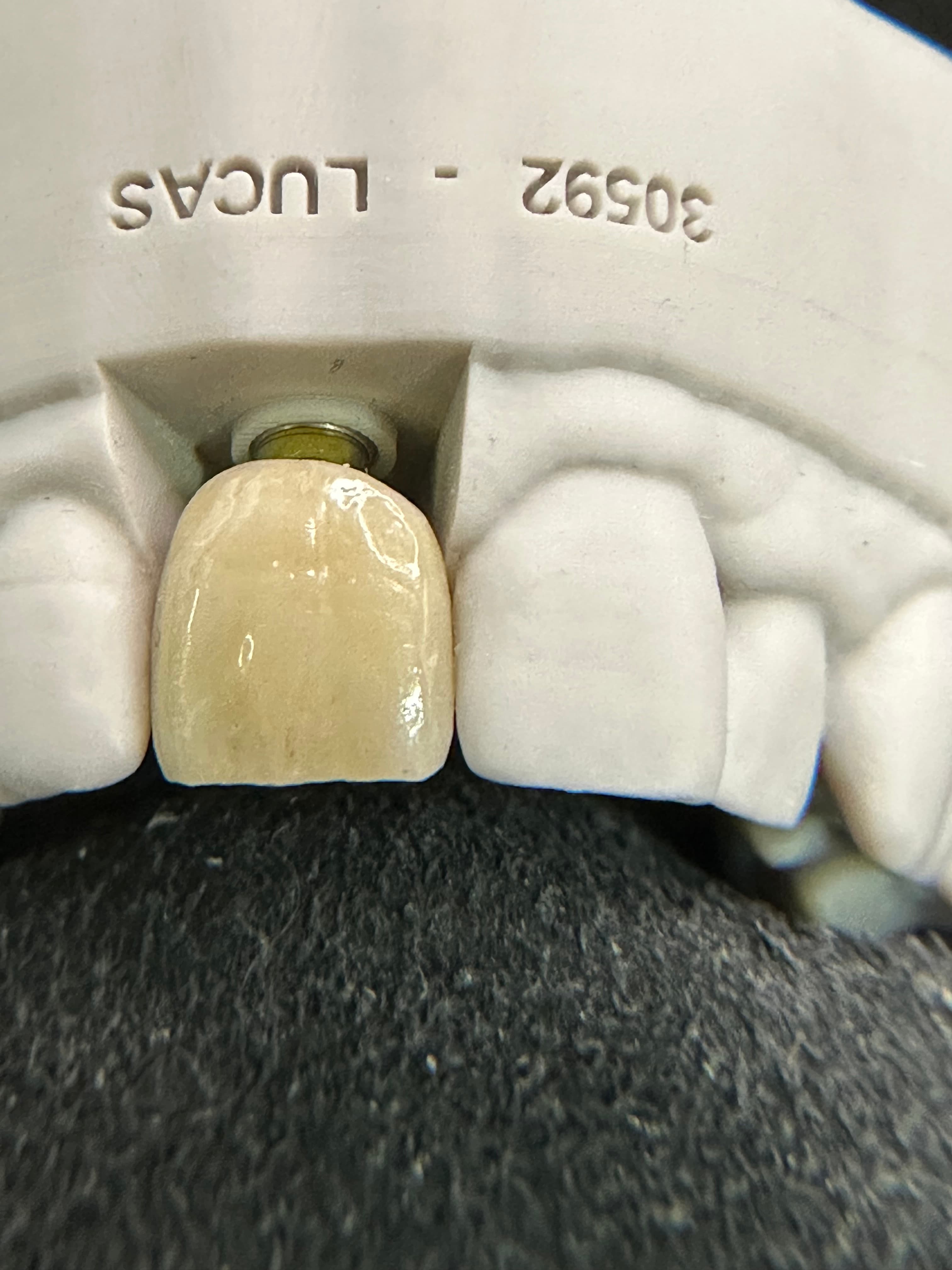 Emergence Critical Central Implant Crowns – image 2