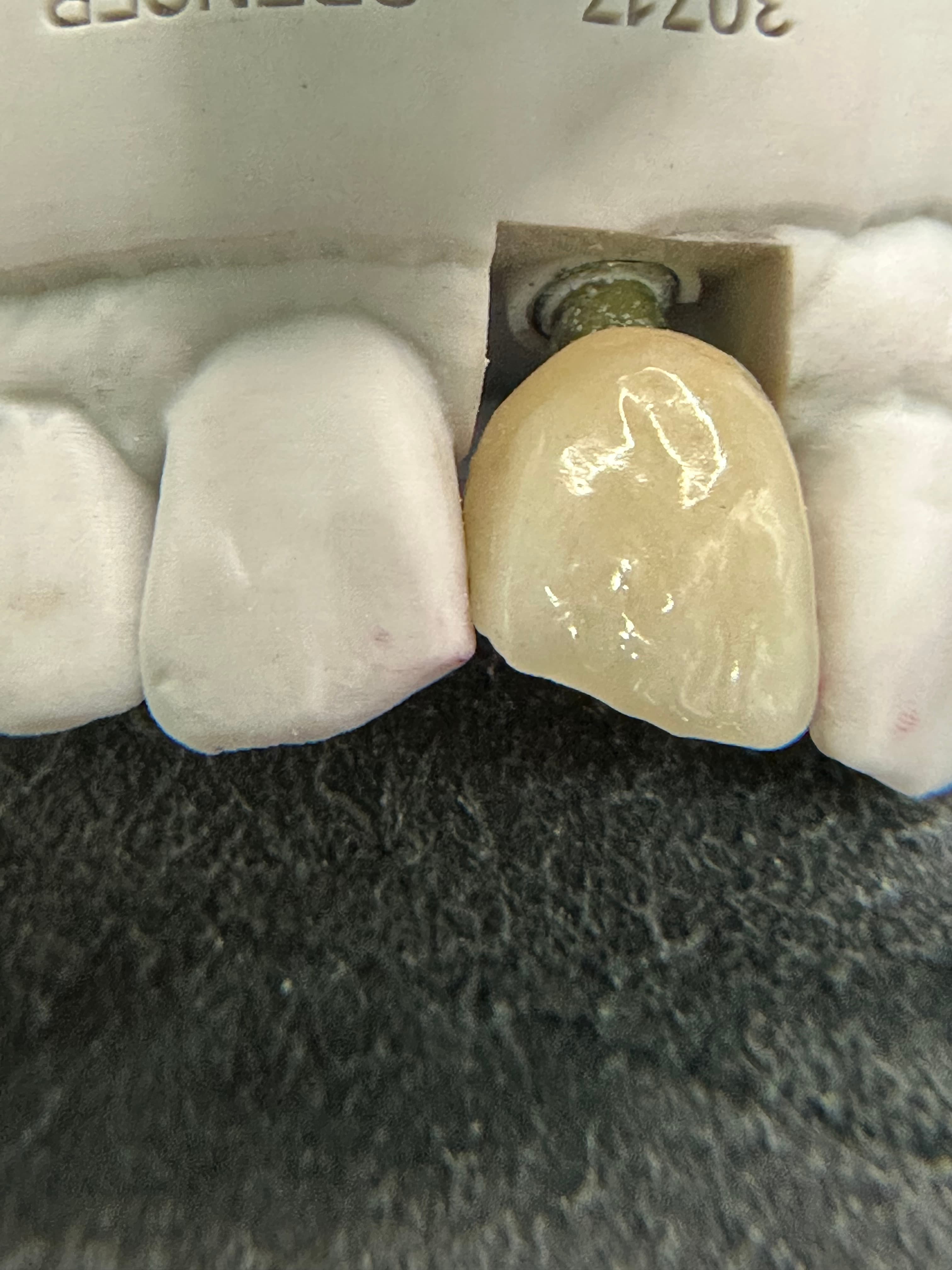Emergence Critical Central Implant Crowns – image 4
