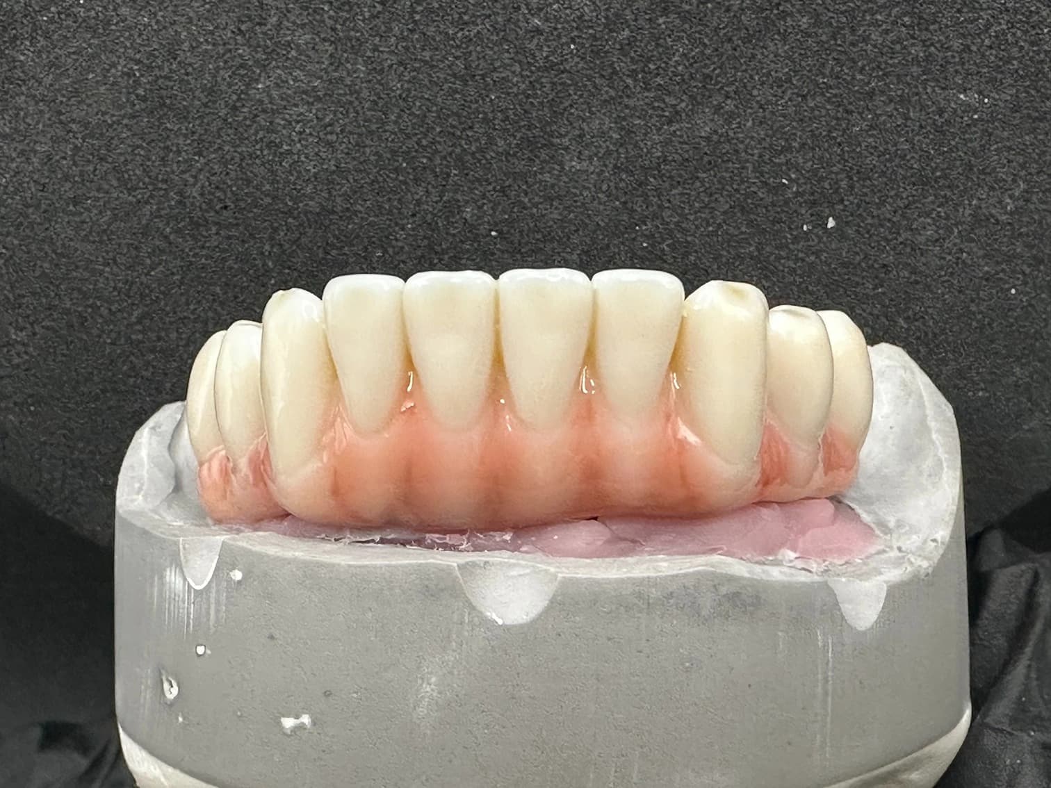 Fully Digitally manufactured All-on-5 Implant Hybrid Bar