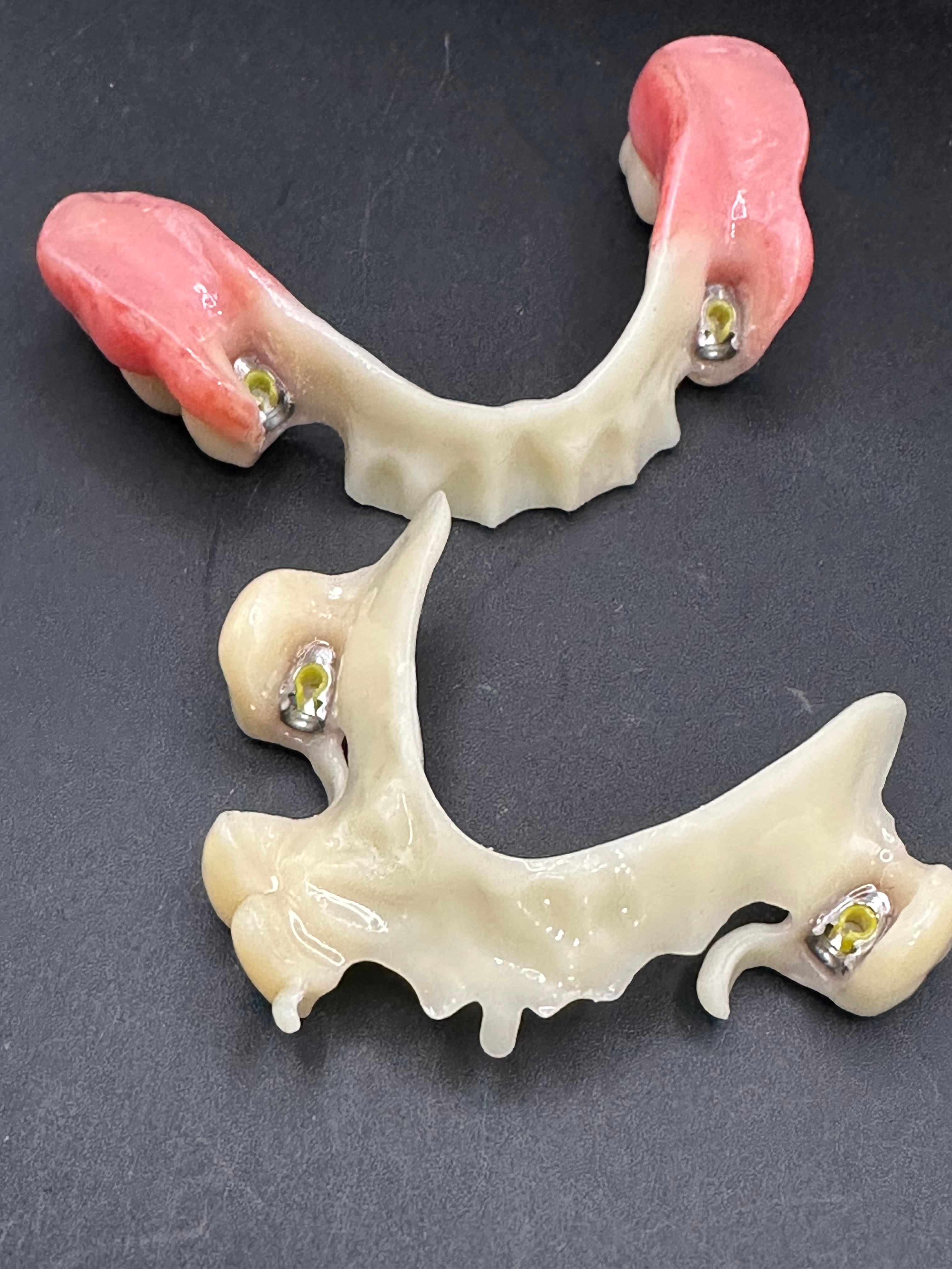 Complex Upper & Lower 3D Printed RPDs