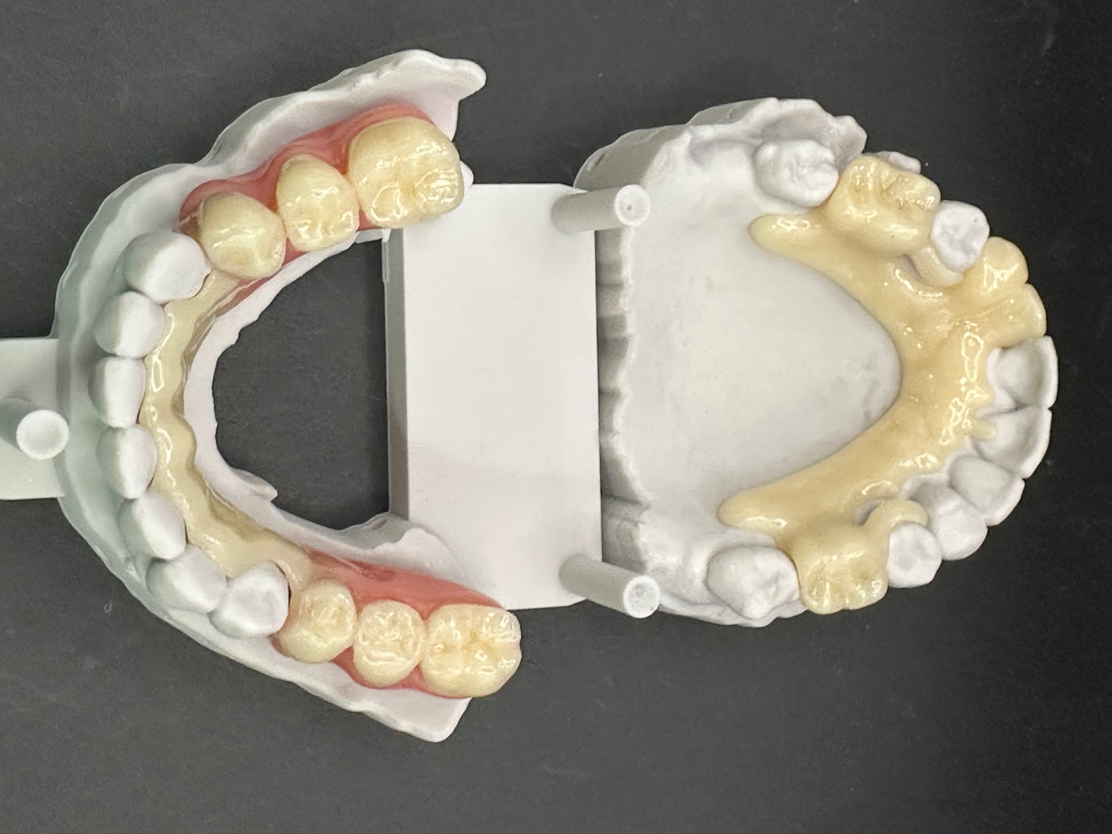 Complex Upper & Lower 3D Printed RPDs – image 2