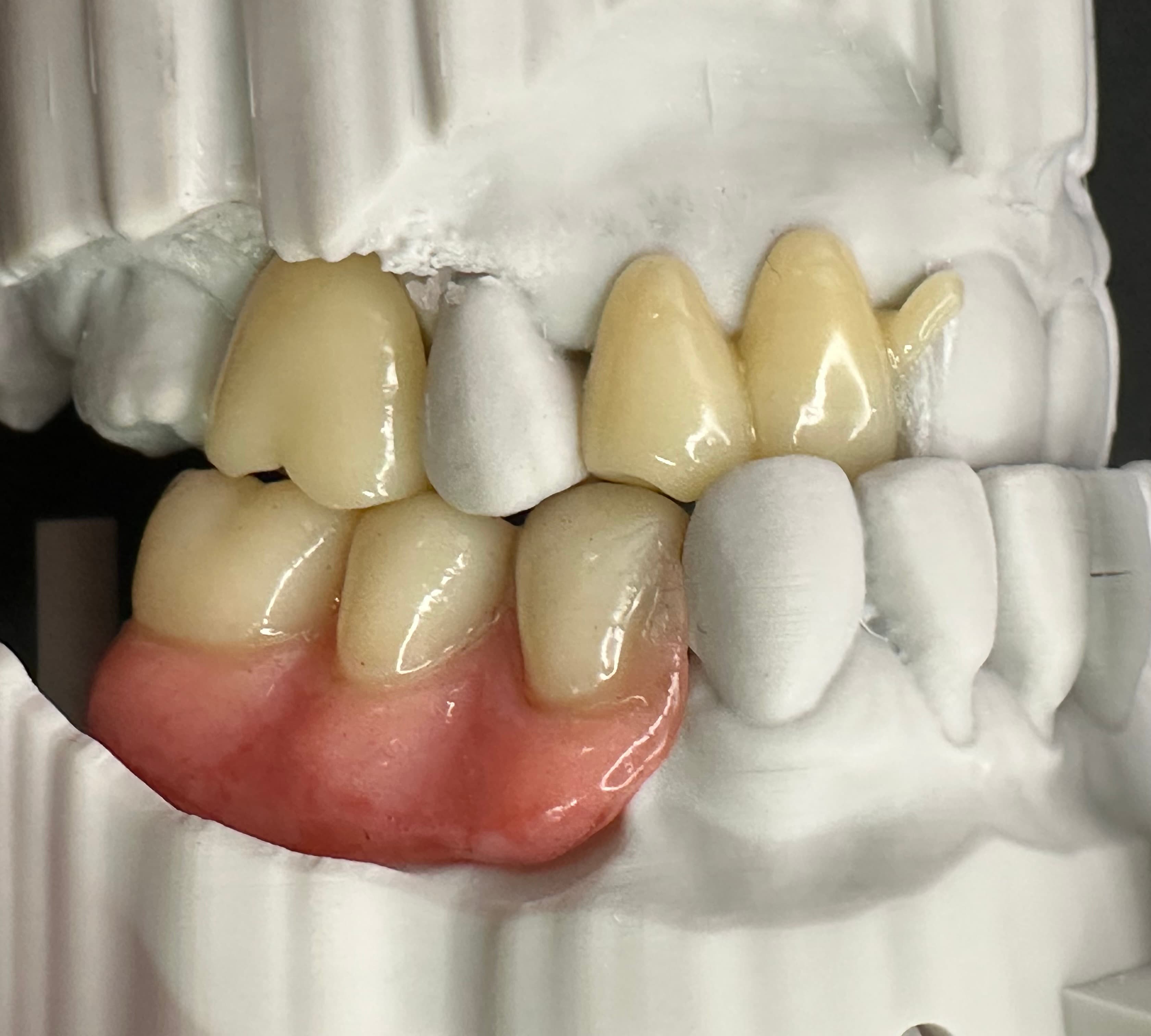 Complex Upper & Lower 3D Printed RPDs – image 4
