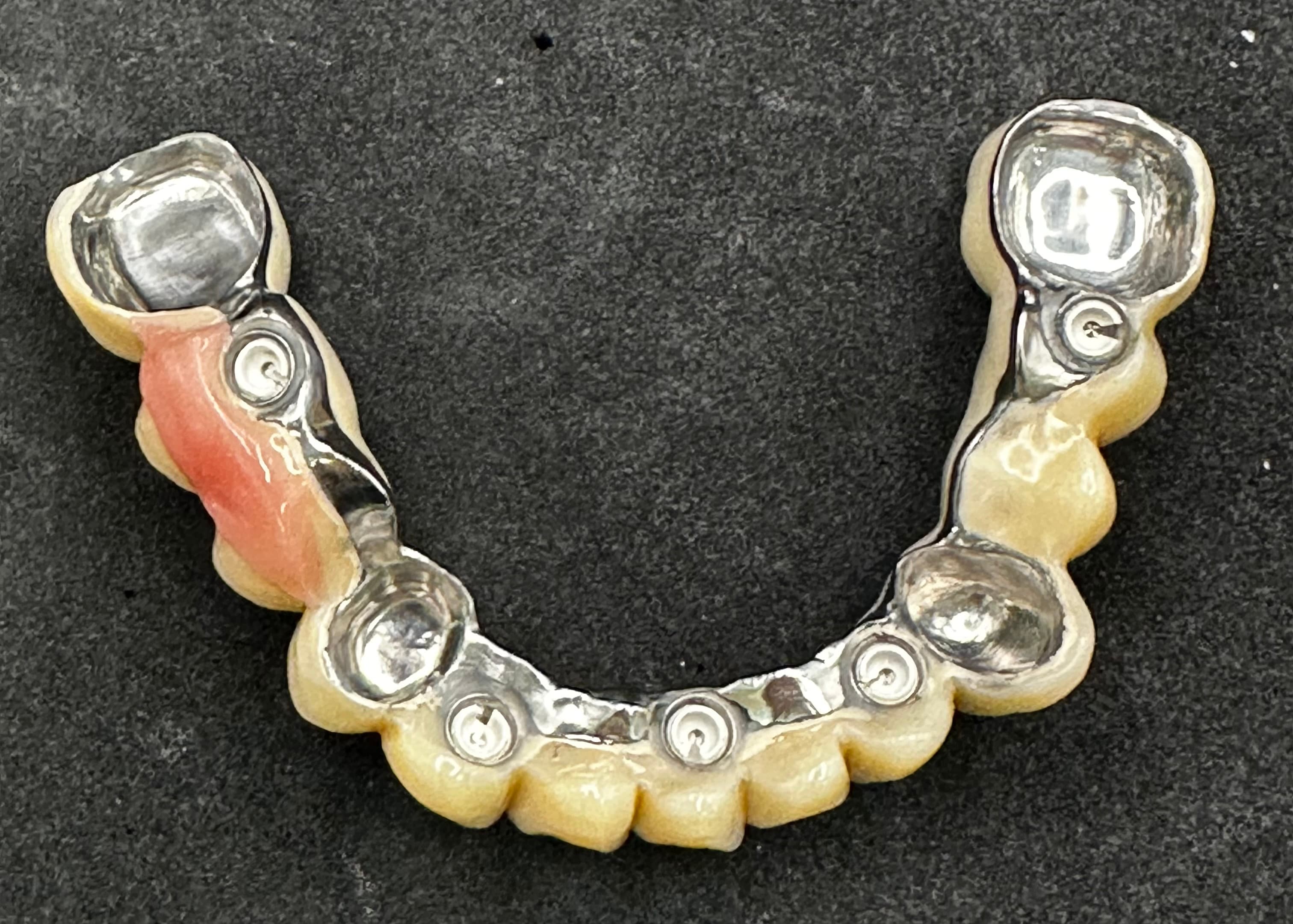 Lower Removable PFM Full Arch Bridge