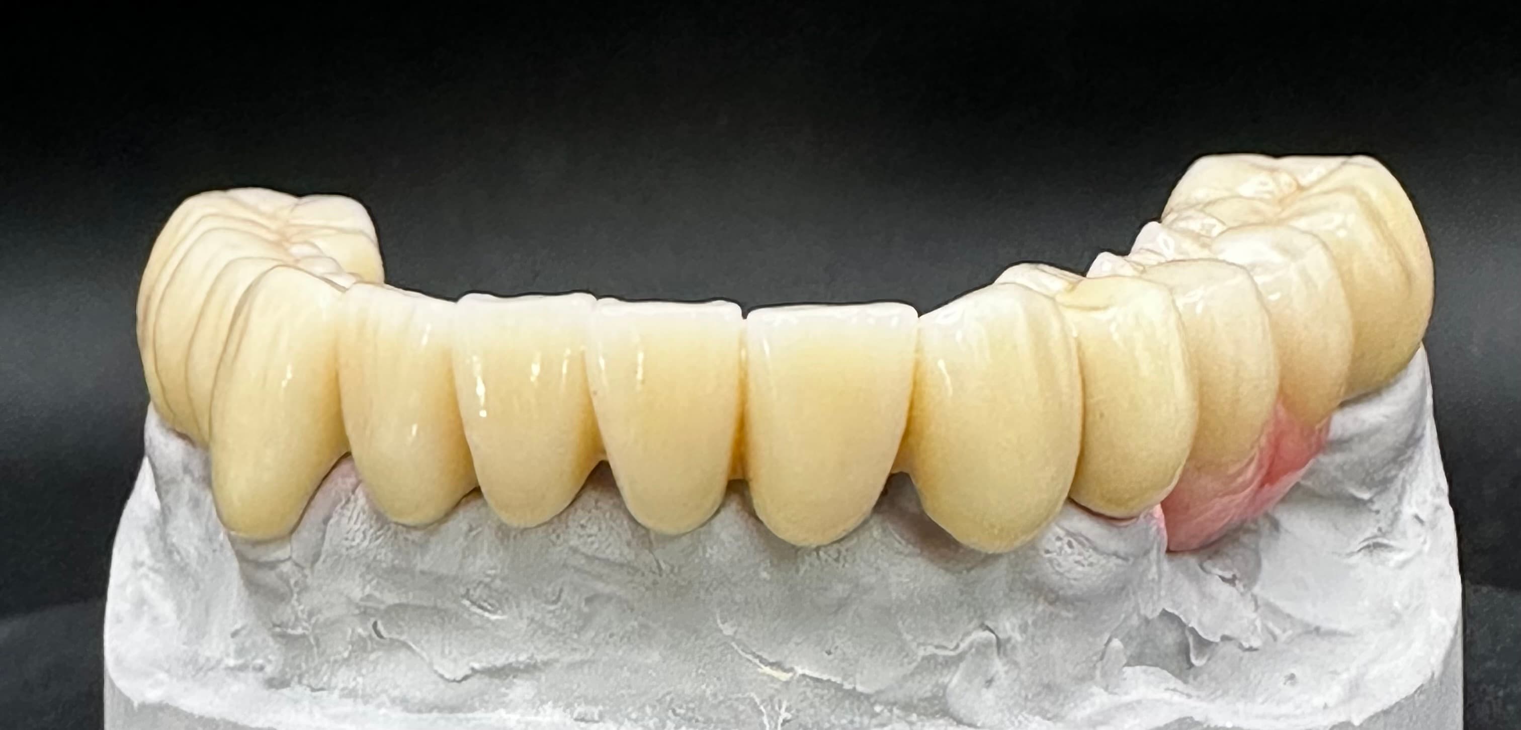 Lower Removable PFM Full Arch Bridge – image 3