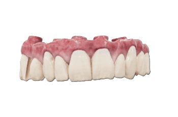 Full Arch Zirconia