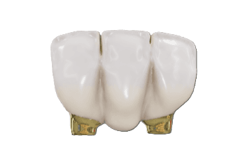 Anterior 3 Unit Bridge