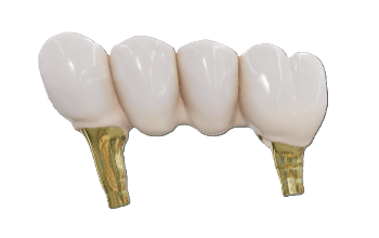 Posterior 3 Unit Bridge