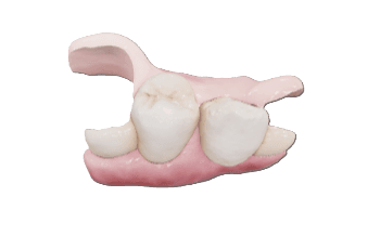 Partial Denture