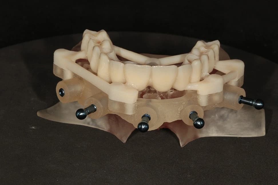 Stage 10: Transitional Bridge in location (post-op)