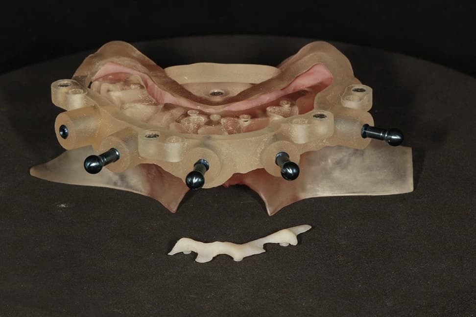 Stage 5: Bone Reduction to Peri-Frame Indicator Level