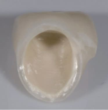 Internal surface of zirconia coping with opaque liquid applied pre-sinter and post-sinter (Images 1 & 2), and true opacity gained (Image 3)