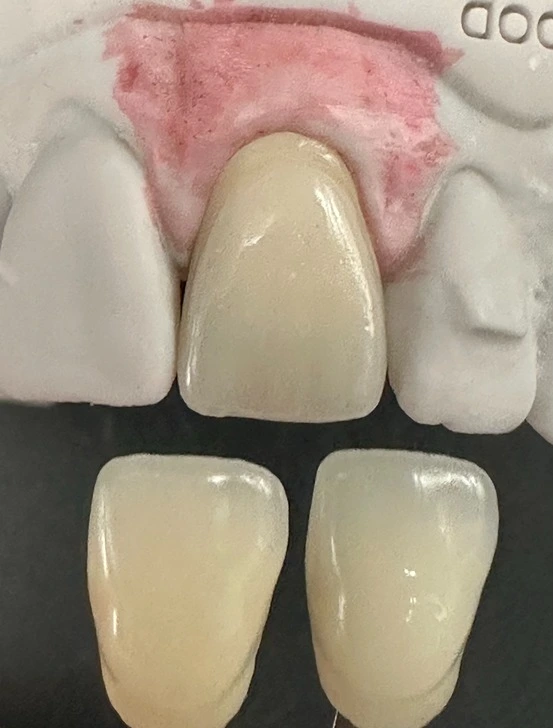 Glaze and fix the shade alteration, polish and test the result