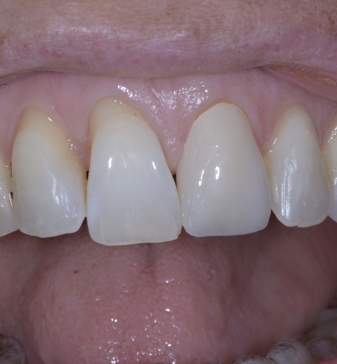 Share adjustment process for layered Zirconia Single Central (21)