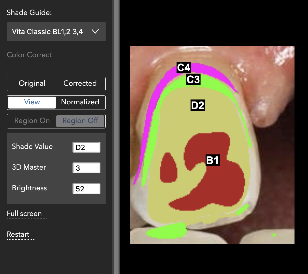Shade-Map overlaid on the target tooth indicating shade zones.