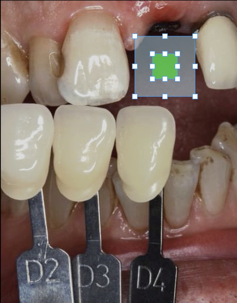 Selecting the gingival 1/3rd of the target tooth for analysis, where highest level of chroma exists.