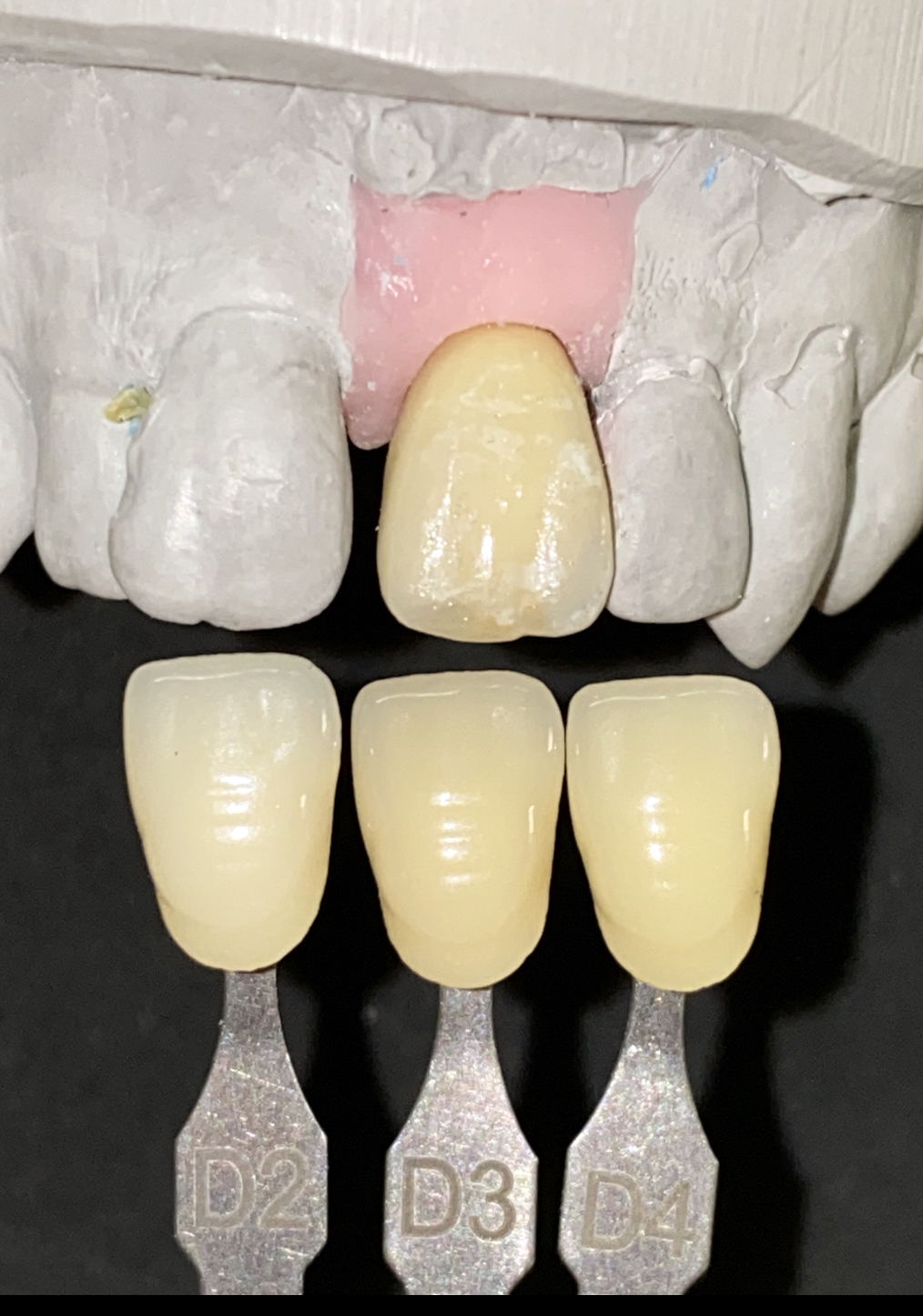 Final crown on the model