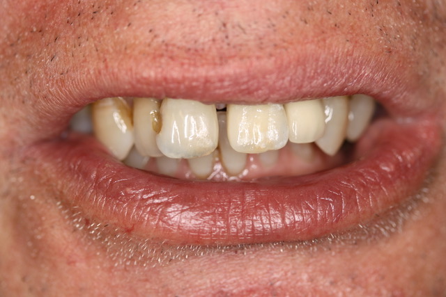 Final crown in the mouth