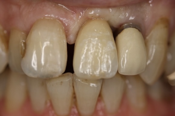 Close-up showing shade match and natural integration.