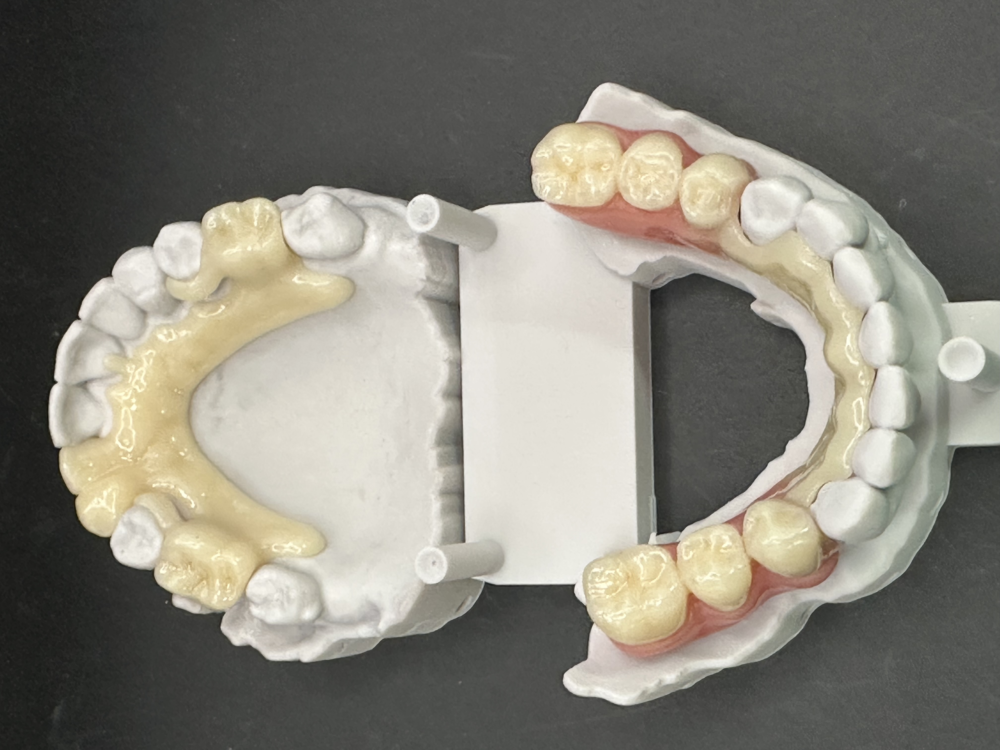 The RPDs located positively on the working 3D models.
