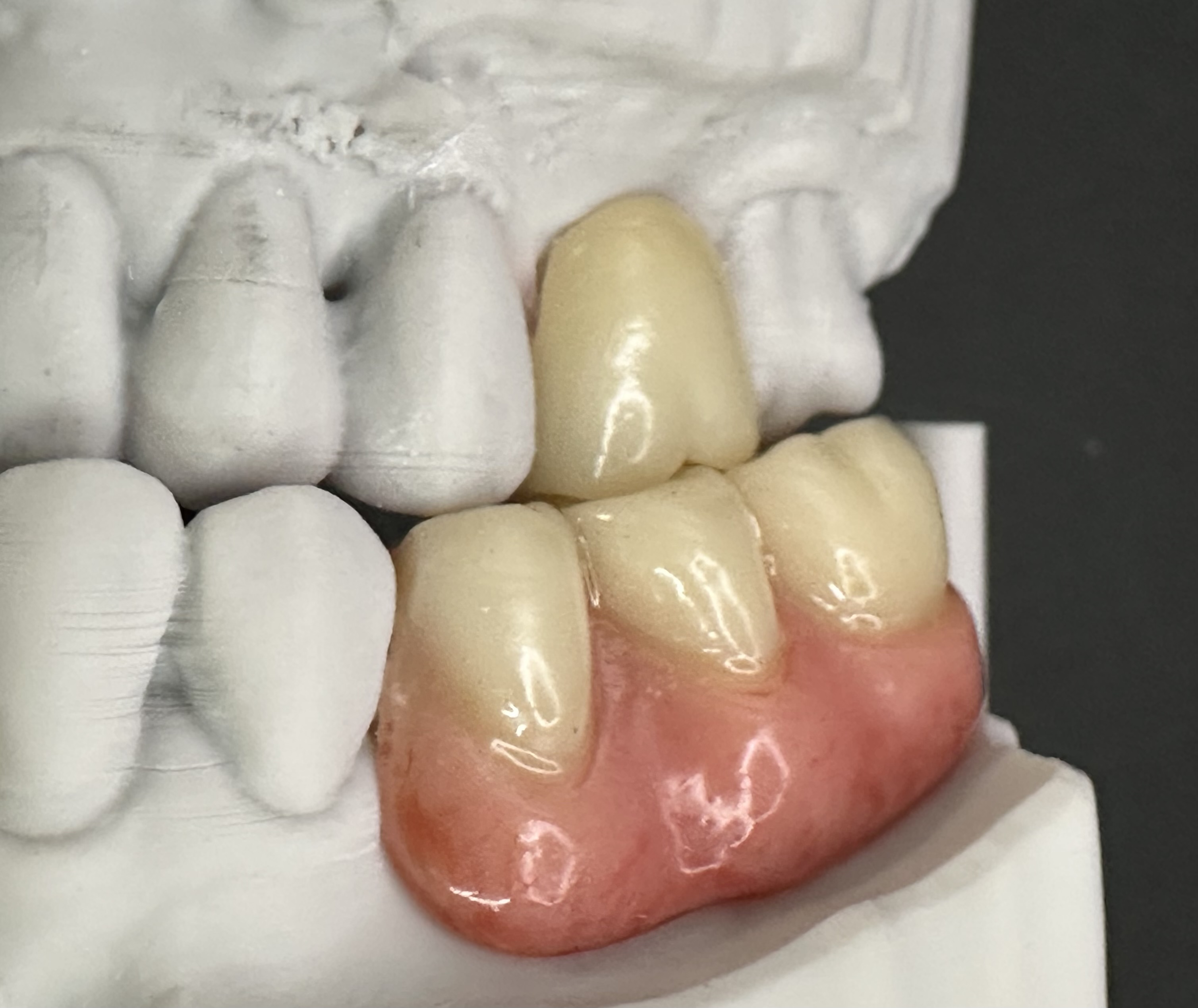 The RPDs harmonising with the natural dentition. Both in appearance and occlusion.