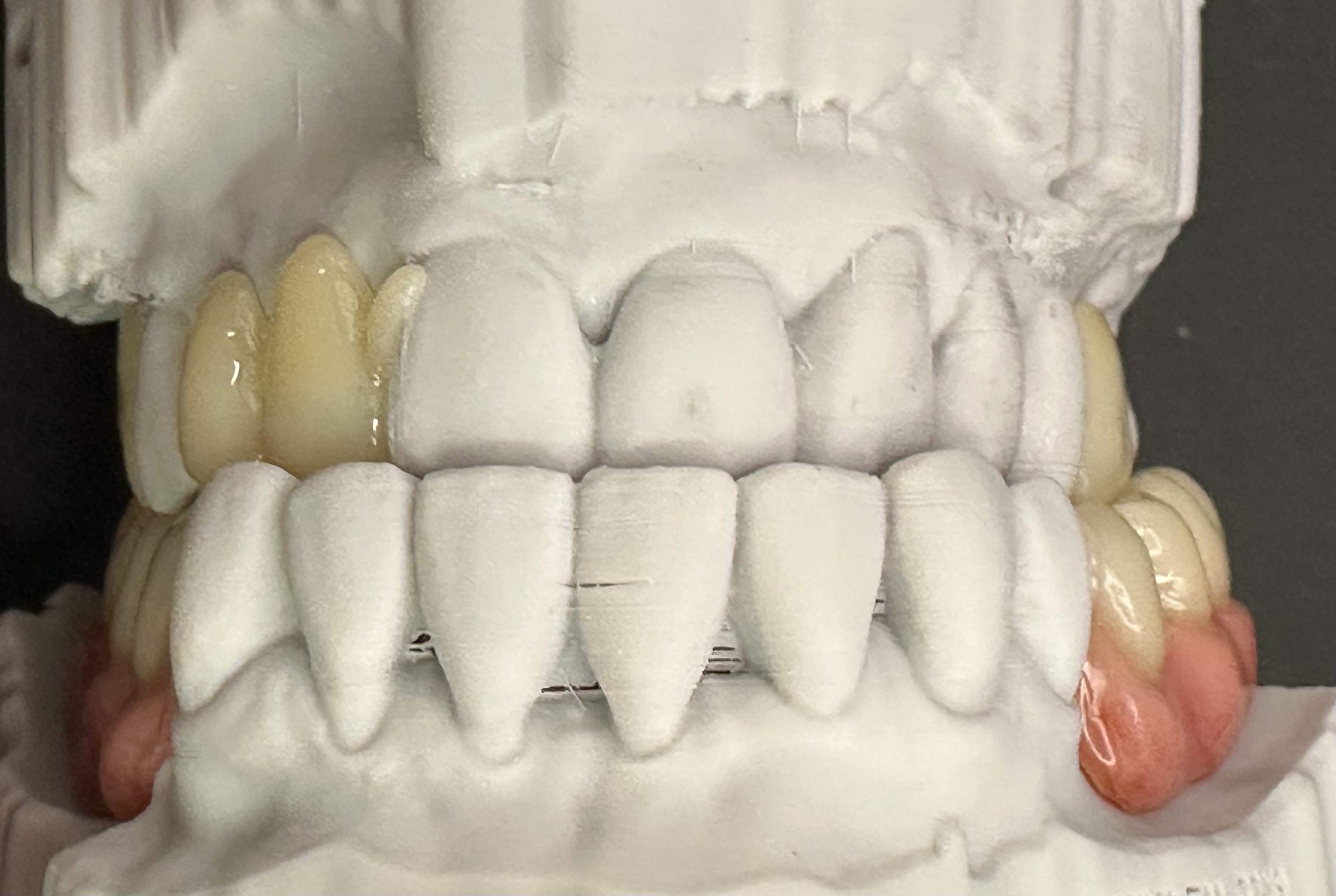 Another benefit of digital production enabling the anterior clasp to be tooth coloured and therefore harmonious with the patients smile.