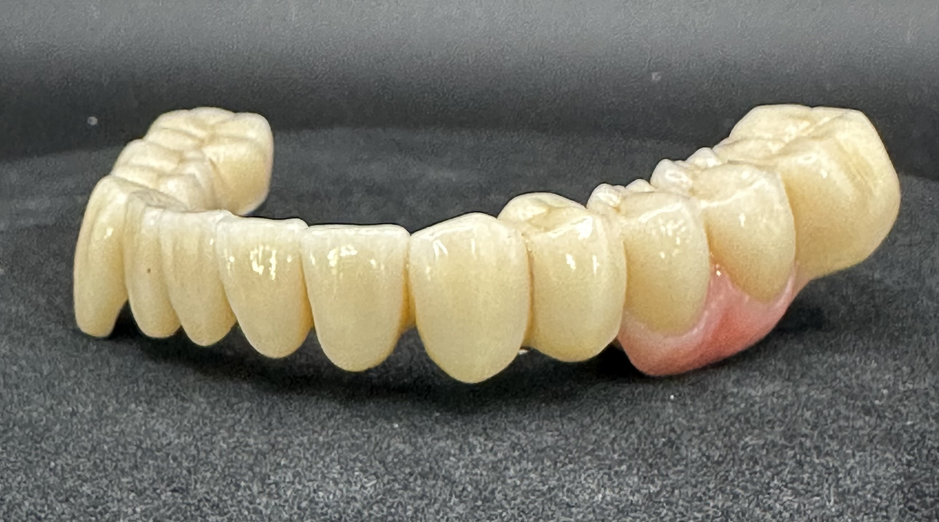 The close adaptation of the Pontic areas to the soft tissue.